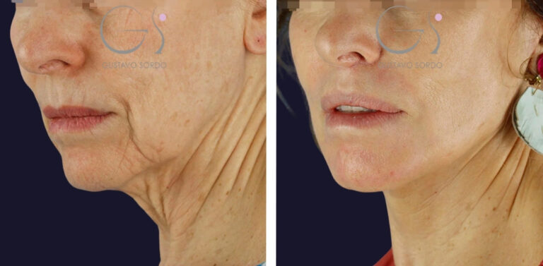 Lifting facial en Madrid