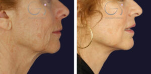 Lifting facial en Madrid