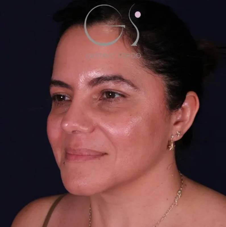 Resultado de rinoplastia latina con injerto de cartílago costal, Dr. Gustavo Sordo, Madrid