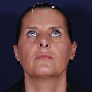 Rinoplastia secundaria, antes de la cirugía — caso operado por el Dr. Gustavo Sordo en Madrid (2)