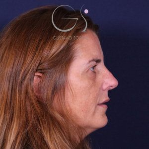 Rinoplastia secundaria, resultado tras la cirugía — caso operado por el Dr. Gustavo Sordo en Madrid (3)