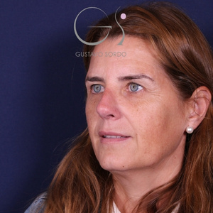 Rinoplastia secundaria, resultado tras la cirugía — caso operado por el Dr. Gustavo Sordo en Madrid (4)