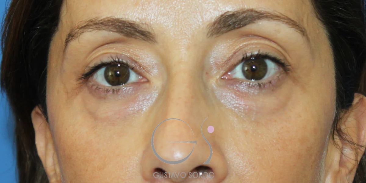 BLEFAROPLASTIA doble en MUJER de 50 años, antes de la cirugía — caso operado por el Dr. Gustavo Sordo en Madrid (1)