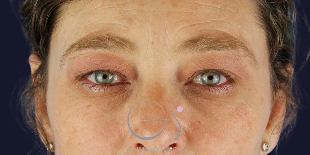 Blefaroplastia en mujer de 55 años: párpados antes de la cirugía, Dr. Gustavo Sordo