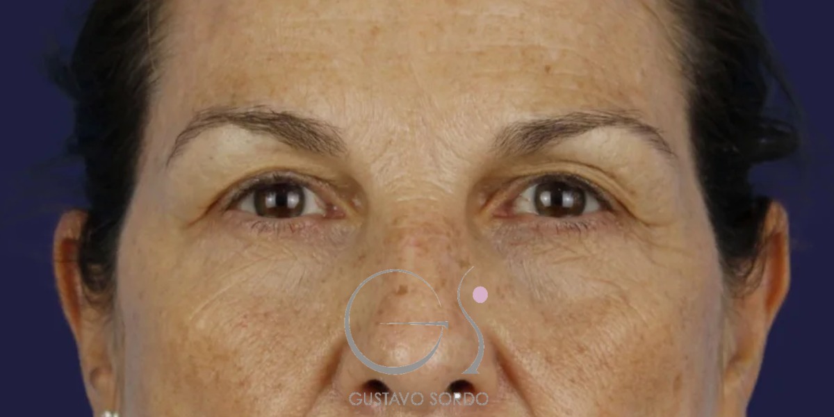 BLEFAROPLASTIA, antes de la cirugía — caso operado por el Dr. Gustavo Sordo en Madrid (1)