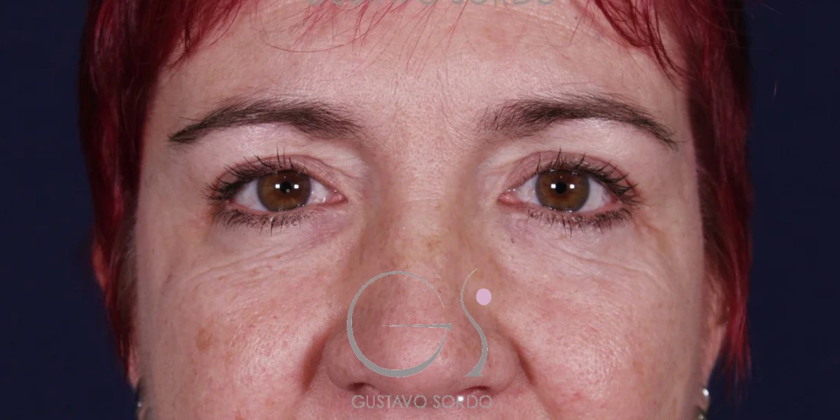 BLEFAROPLASTIA, antes de la cirugía — caso operado por el Dr. Gustavo Sordo en Madrid (1)