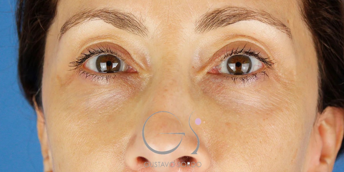 BLEFAROPLASTIA doble en MUJER de 50 años, resultado tras la cirugía — caso operado por el Dr. Gustavo Sordo en Madrid (1)