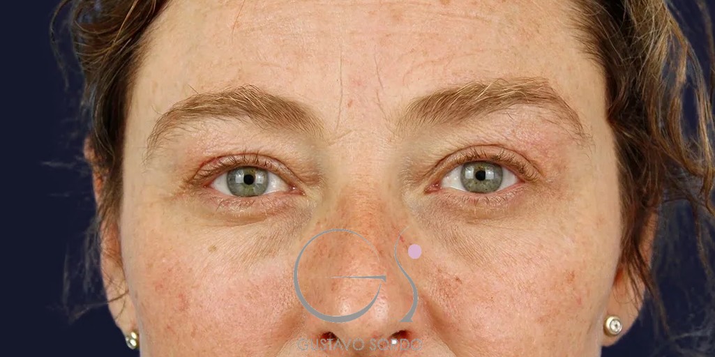 Blefaroplastia: resultado en los párpados, caso operado por el Dr. Gustavo Sordo