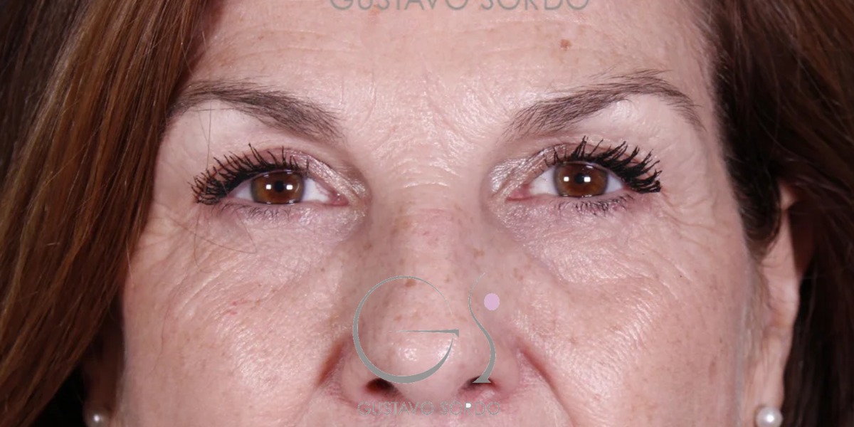 BLEFAROPLASTIA, resultado tras la cirugía — caso operado por el Dr. Gustavo Sordo en Madrid (1)