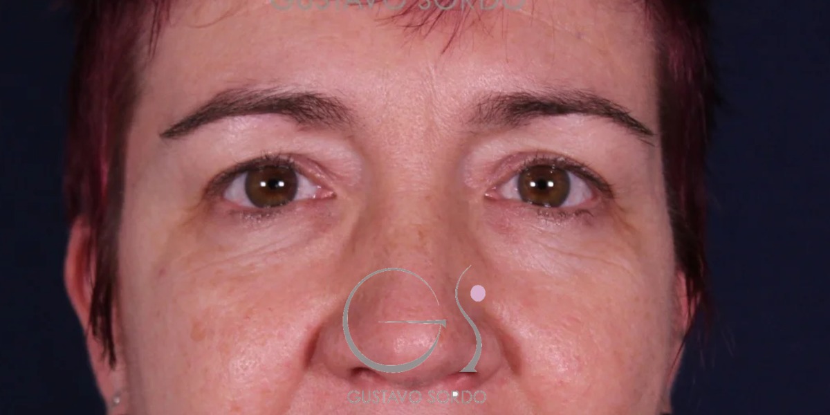 BLEFAROPLASTIA, resultado tras la cirugía — caso operado por el Dr. Gustavo Sordo en Madrid (1)