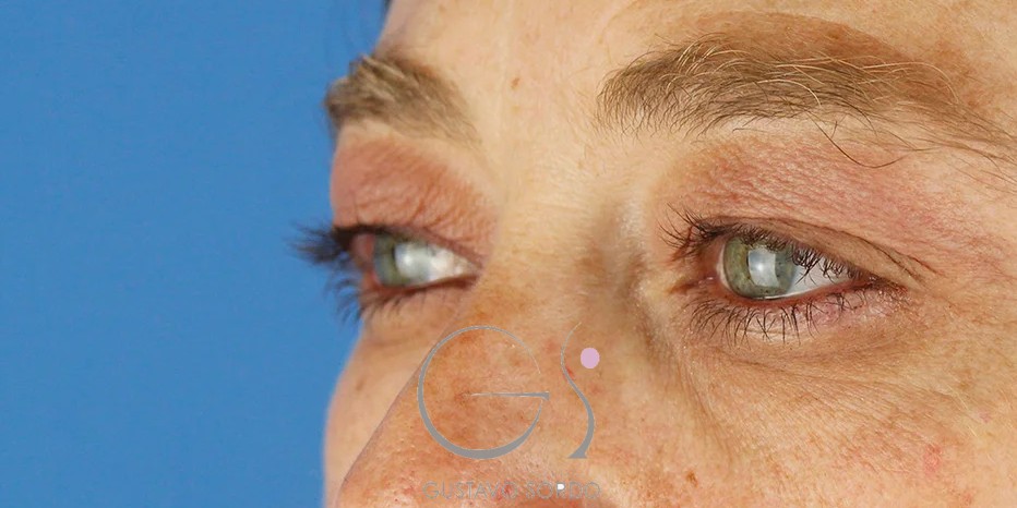 Blefaroplastia en mujer de 55 años, antes de la cirugía — caso operado por el Dr. Gustavo Sordo en Madrid (2)