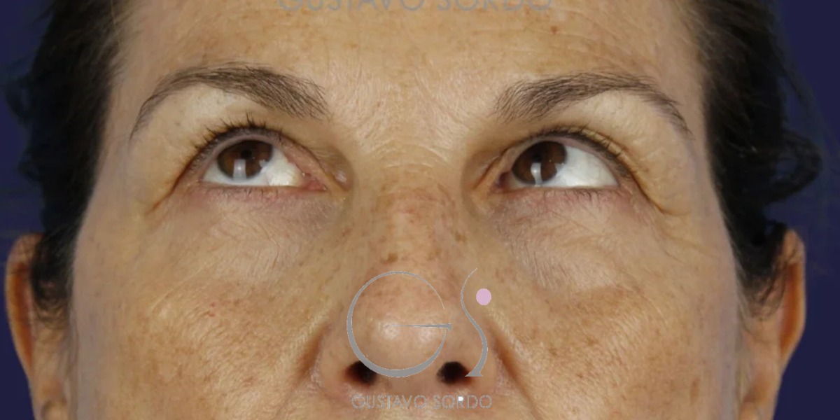 BLEFAROPLASTIA, antes de la cirugía — caso operado por el Dr. Gustavo Sordo en Madrid (2)