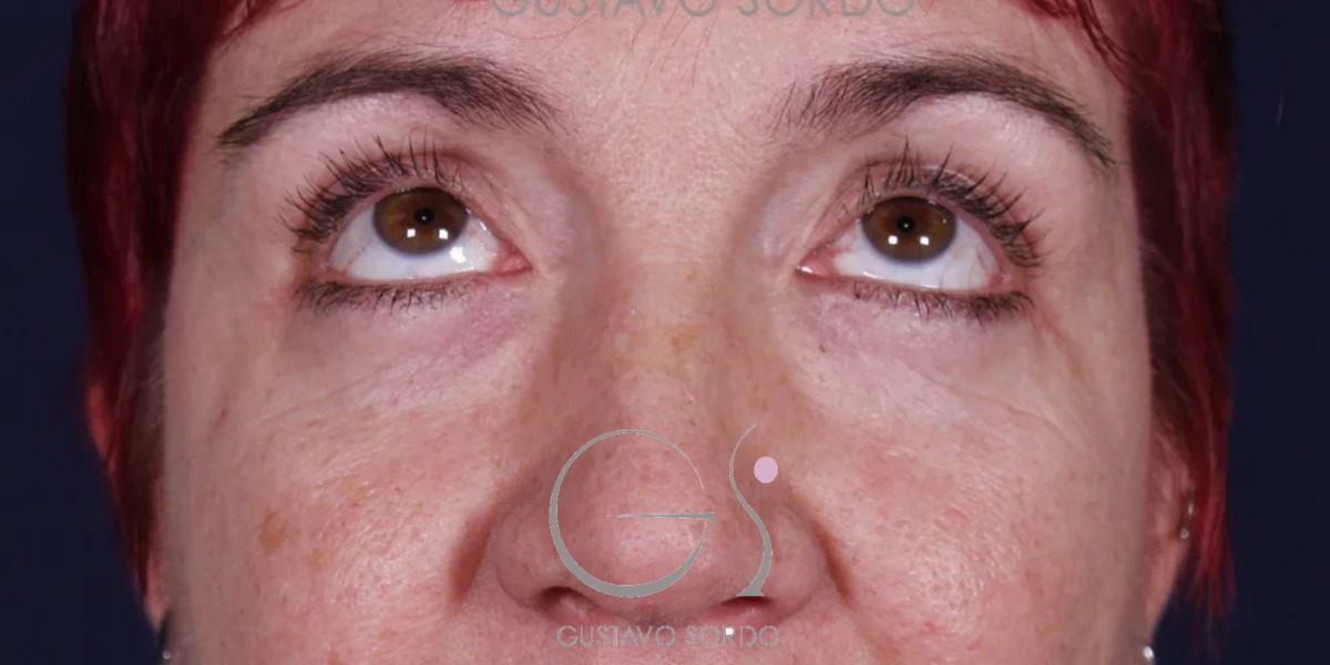 BLEFAROPLASTIA, antes de la cirugía — caso operado por el Dr. Gustavo Sordo en Madrid (2)