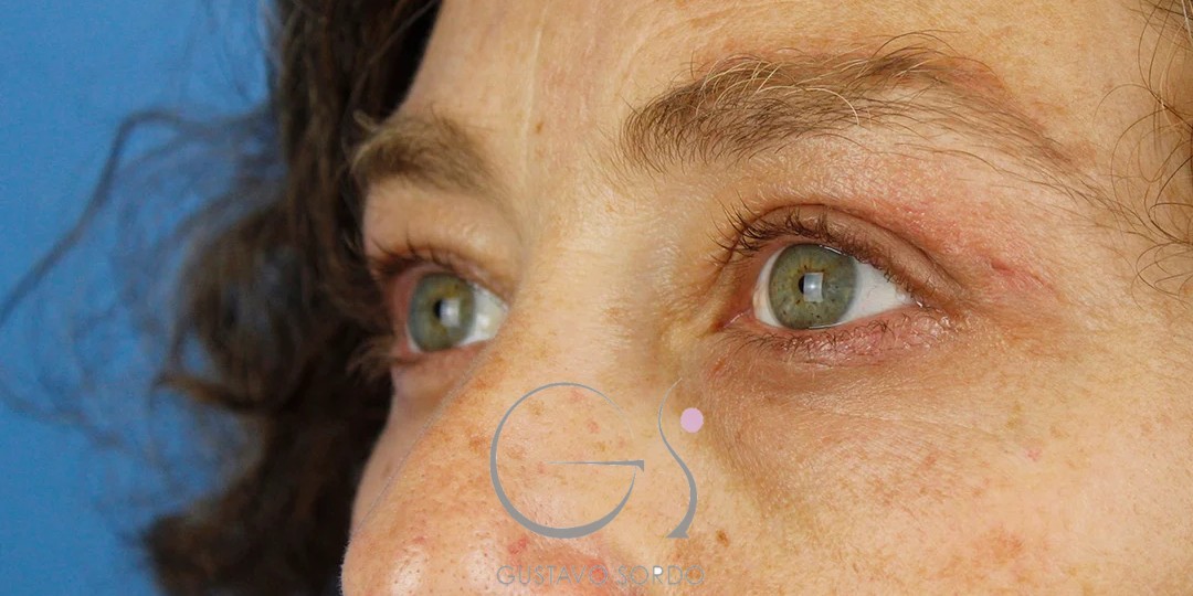 Blefaroplastia en mujer de 55 años, resultado tras la cirugía — caso operado por el Dr. Gustavo Sordo en Madrid (2)