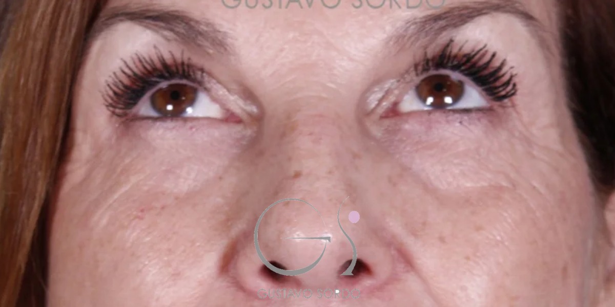BLEFAROPLASTIA, resultado tras la cirugía — caso operado por el Dr. Gustavo Sordo en Madrid (2)
