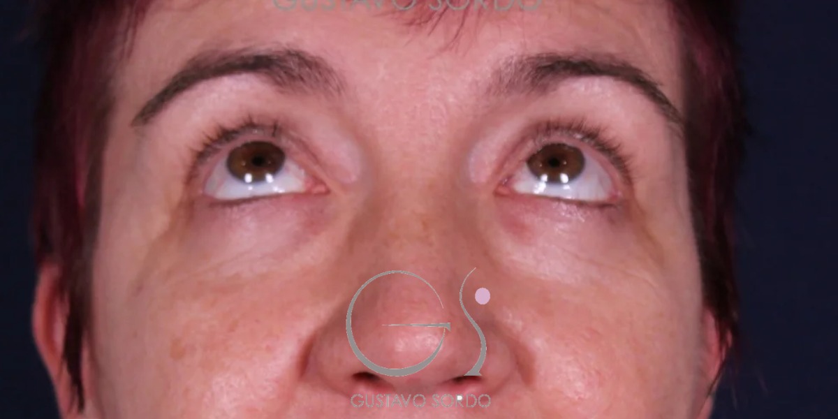 BLEFAROPLASTIA, resultado tras la cirugía — caso operado por el Dr. Gustavo Sordo en Madrid (2)