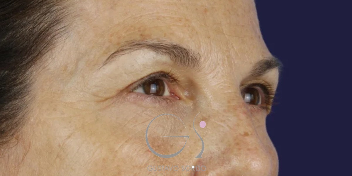 BLEFAROPLASTIA, antes de la cirugía — caso operado por el Dr. Gustavo Sordo en Madrid (3)