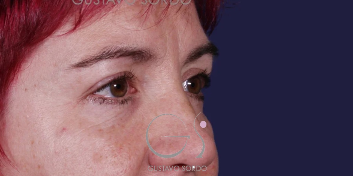 BLEFAROPLASTIA, antes de la cirugía — caso operado por el Dr. Gustavo Sordo en Madrid (3)