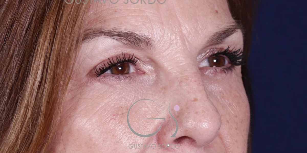 BLEFAROPLASTIA, resultado tras la cirugía — caso operado por el Dr. Gustavo Sordo en Madrid (3)