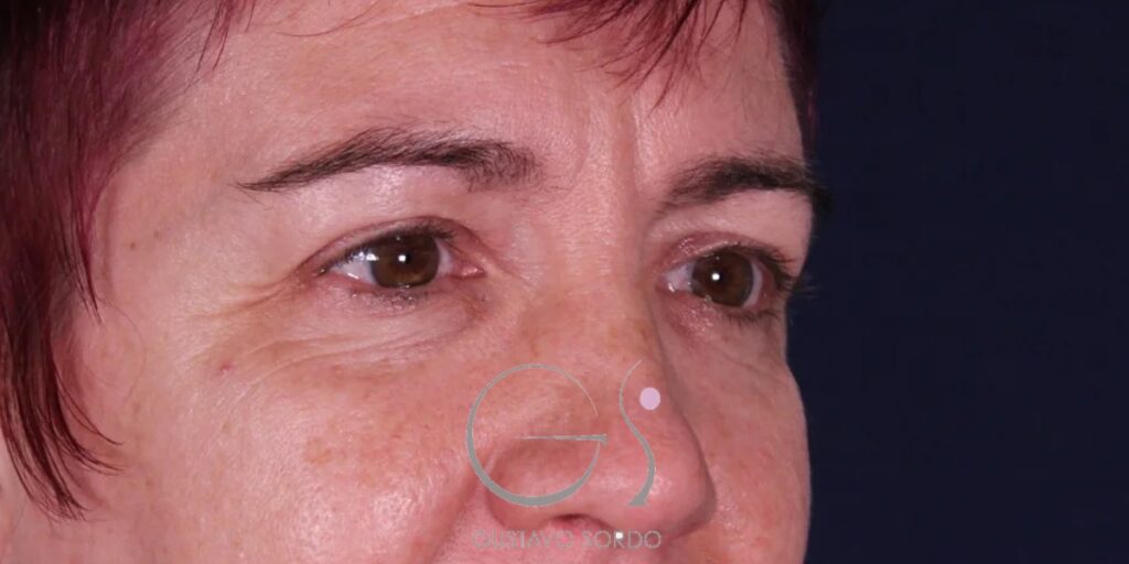 blefaroplastia mujer antes y despues
