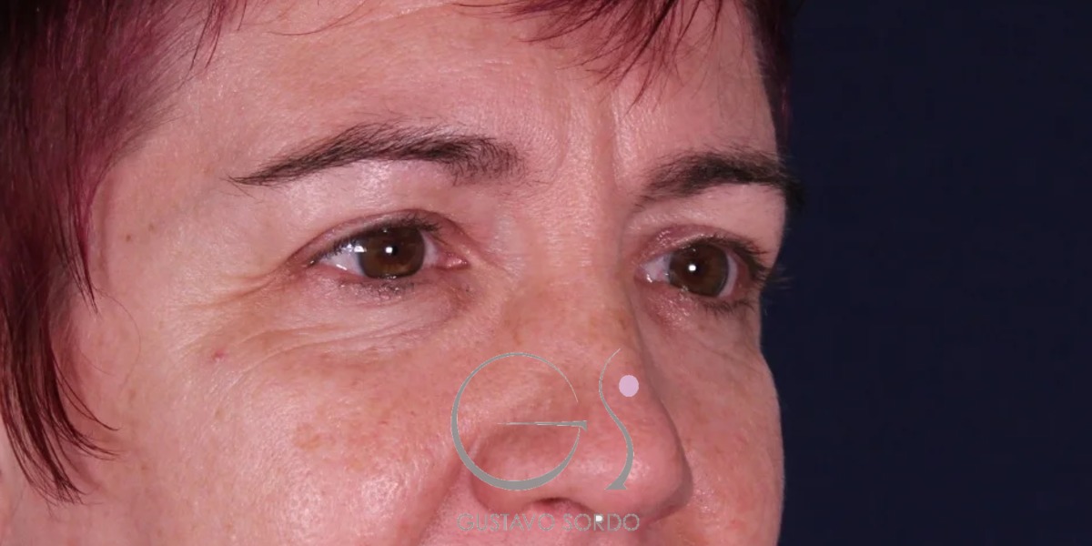 BLEFAROPLASTIA, resultado tras la cirugía — caso operado por el Dr. Gustavo Sordo en Madrid (3)