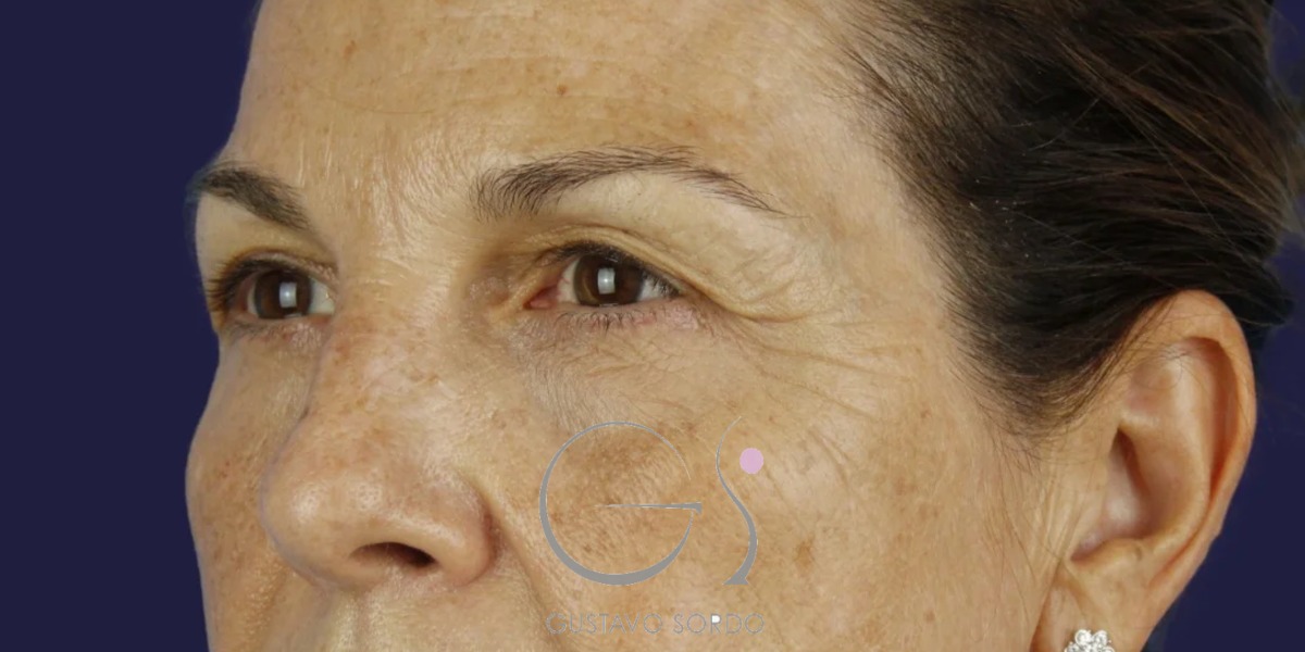 BLEFAROPLASTIA, antes de la cirugía — caso operado por el Dr. Gustavo Sordo en Madrid (4)