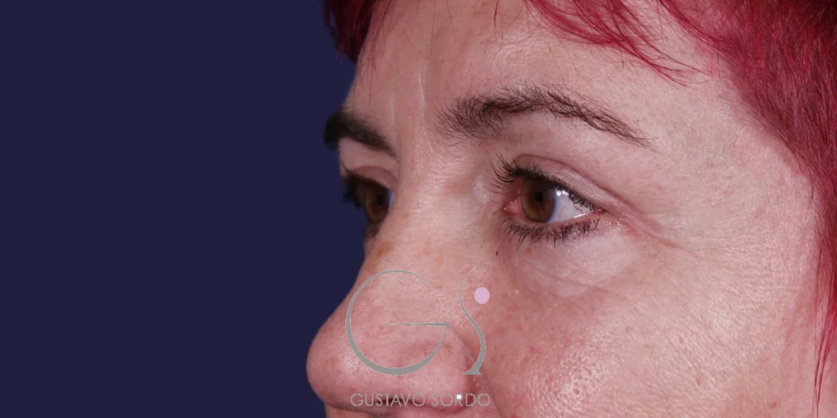 BLEFAROPLASTIA, antes de la cirugía — caso operado por el Dr. Gustavo Sordo en Madrid (4)