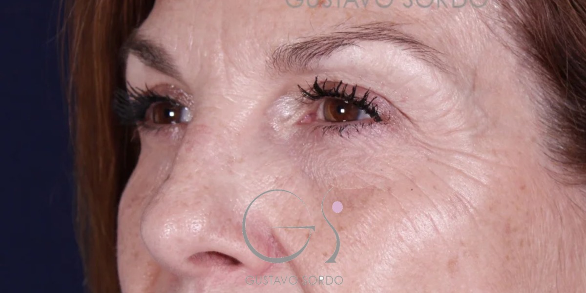 BLEFAROPLASTIA, resultado tras la cirugía — caso operado por el Dr. Gustavo Sordo en Madrid (4)