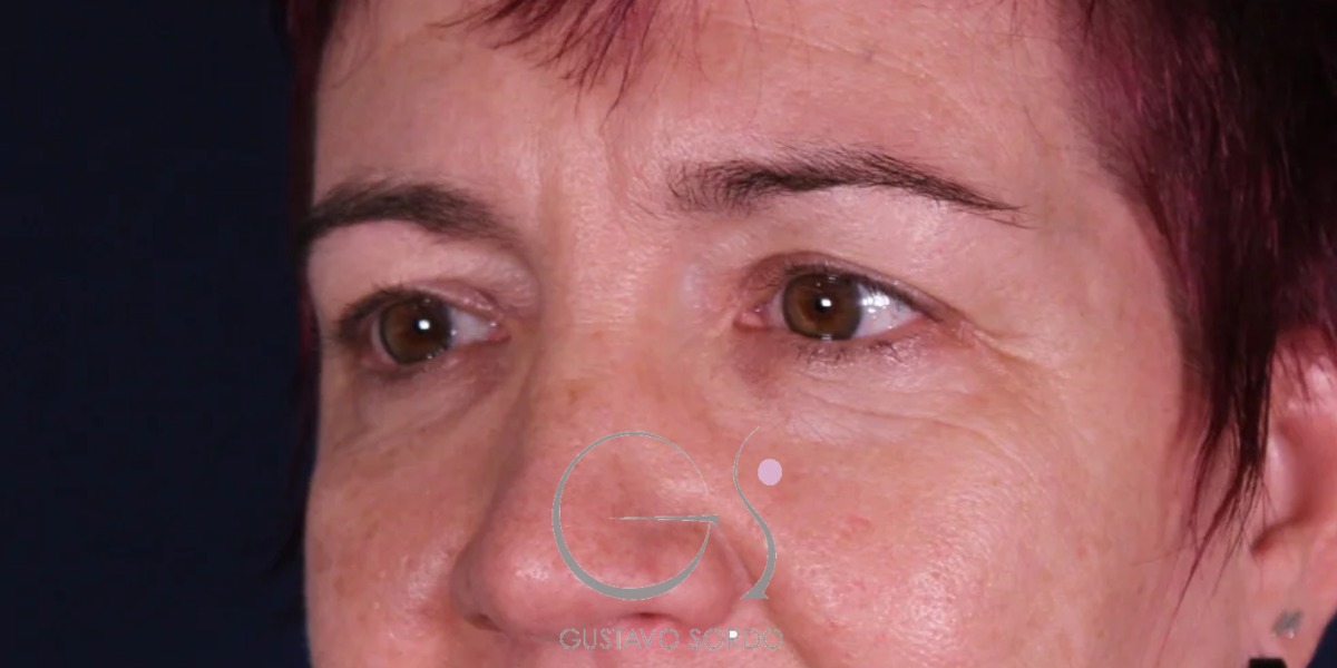 BLEFAROPLASTIA, resultado tras la cirugía — caso operado por el Dr. Gustavo Sordo en Madrid (4)