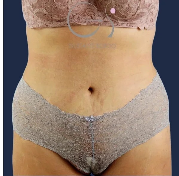 عملية تجميل البطن: نتيجة حالة خضعت لعملية جراحية في العيادة
