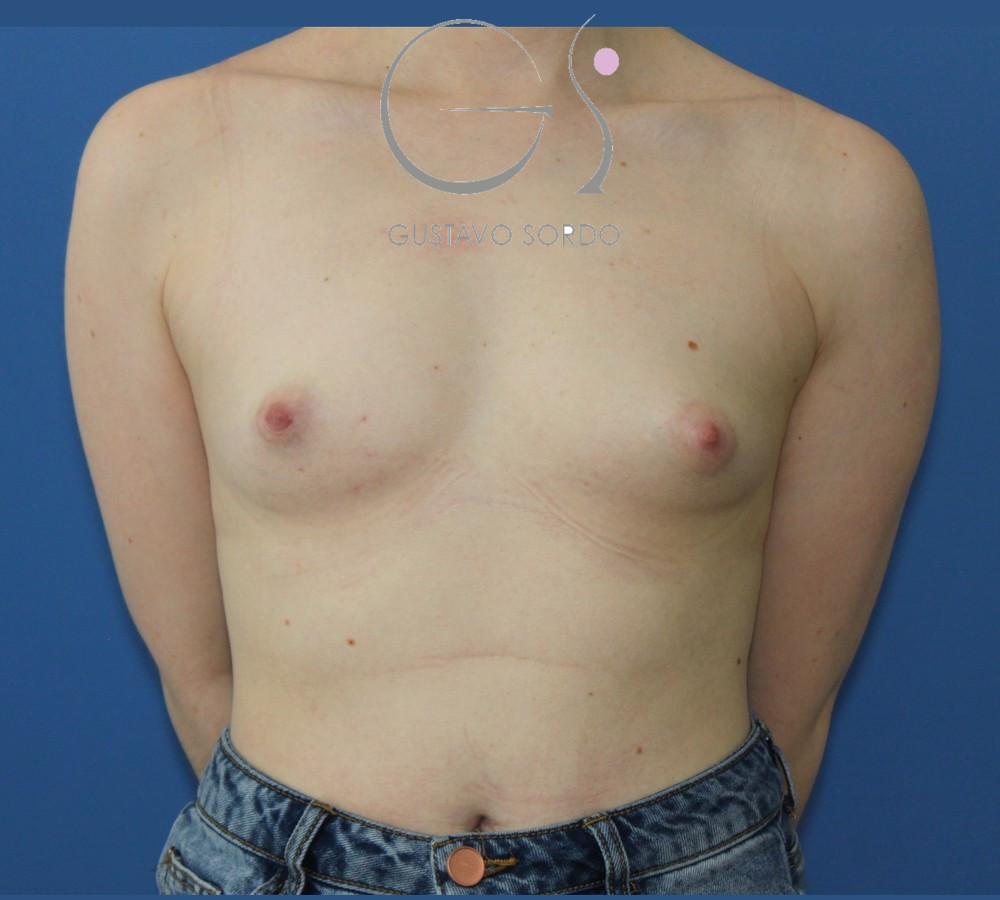 Mama tuberosa corregida con prótesis anatómicas de 345 cc: antes, vista frontal