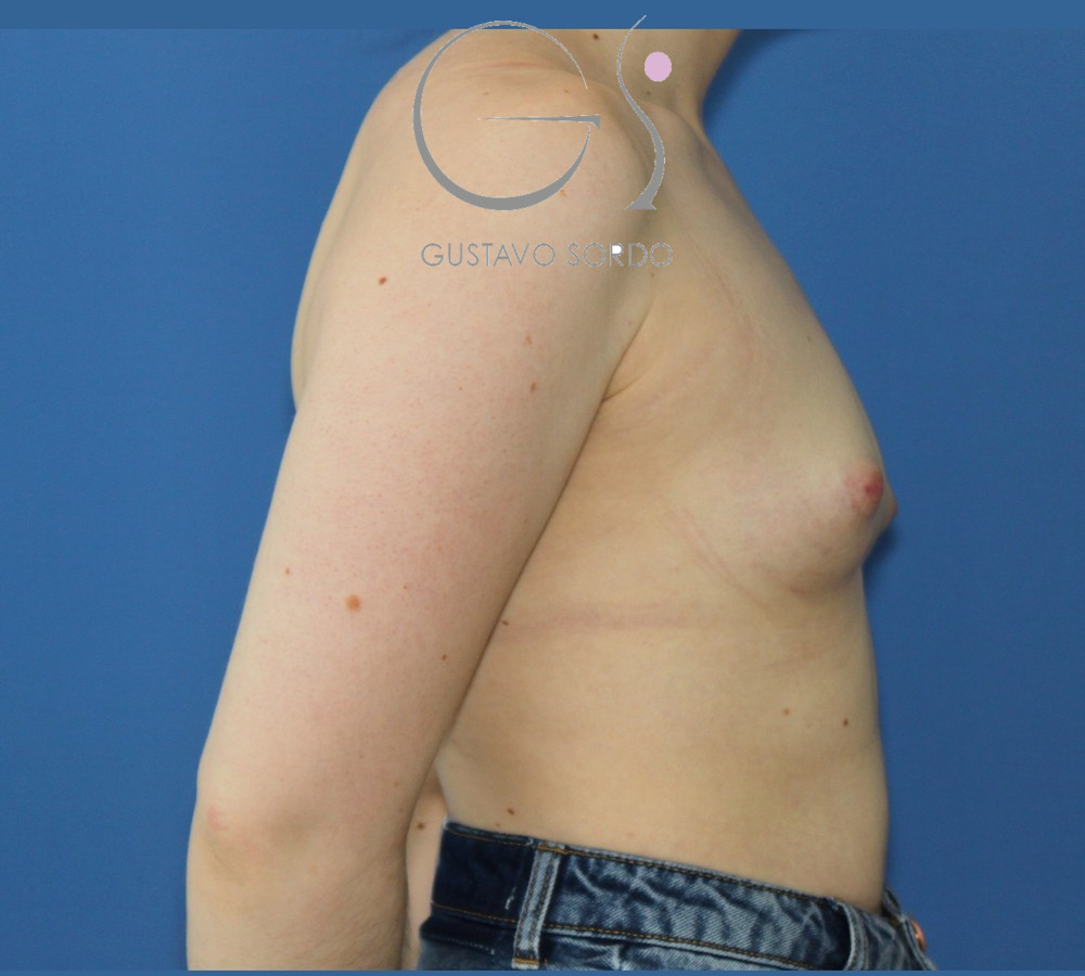 Mama tuberosa corregida con prótesis anatómicas de 345 cc: antes, perfil derecho