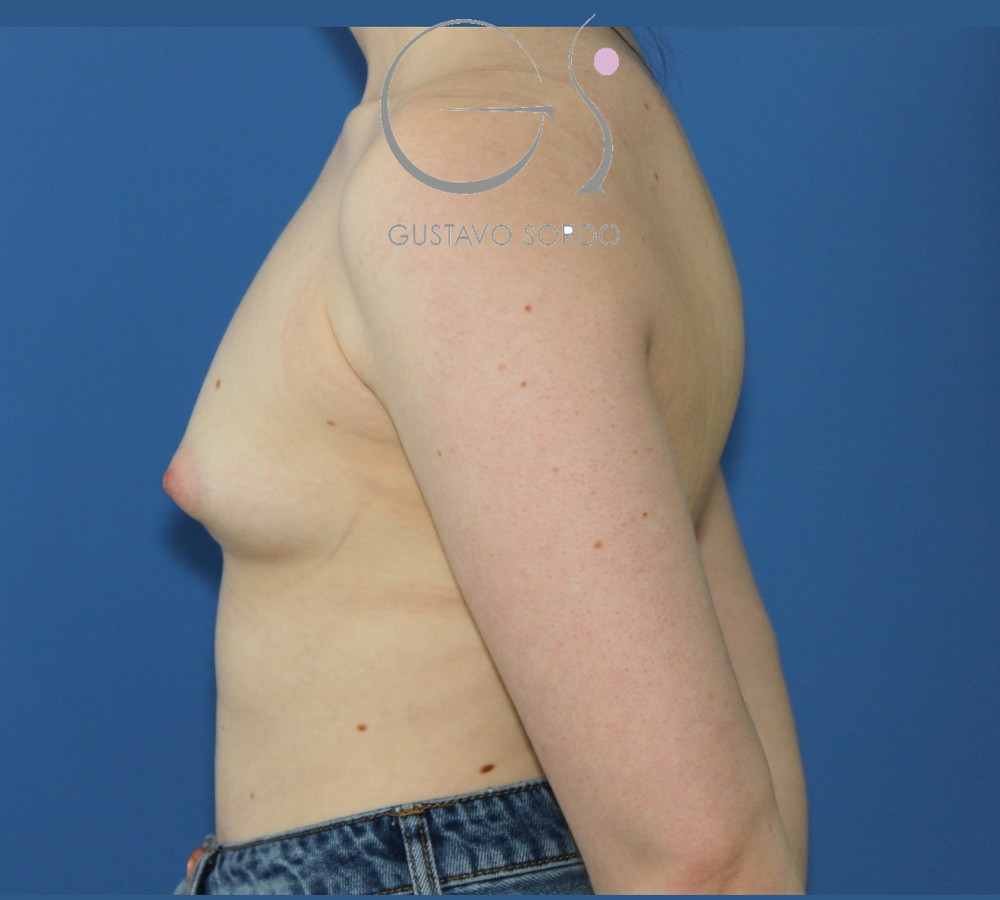 Mama tuberosa corregida con prótesis anatómicas de 345 cc: antes, perfil izquierdo