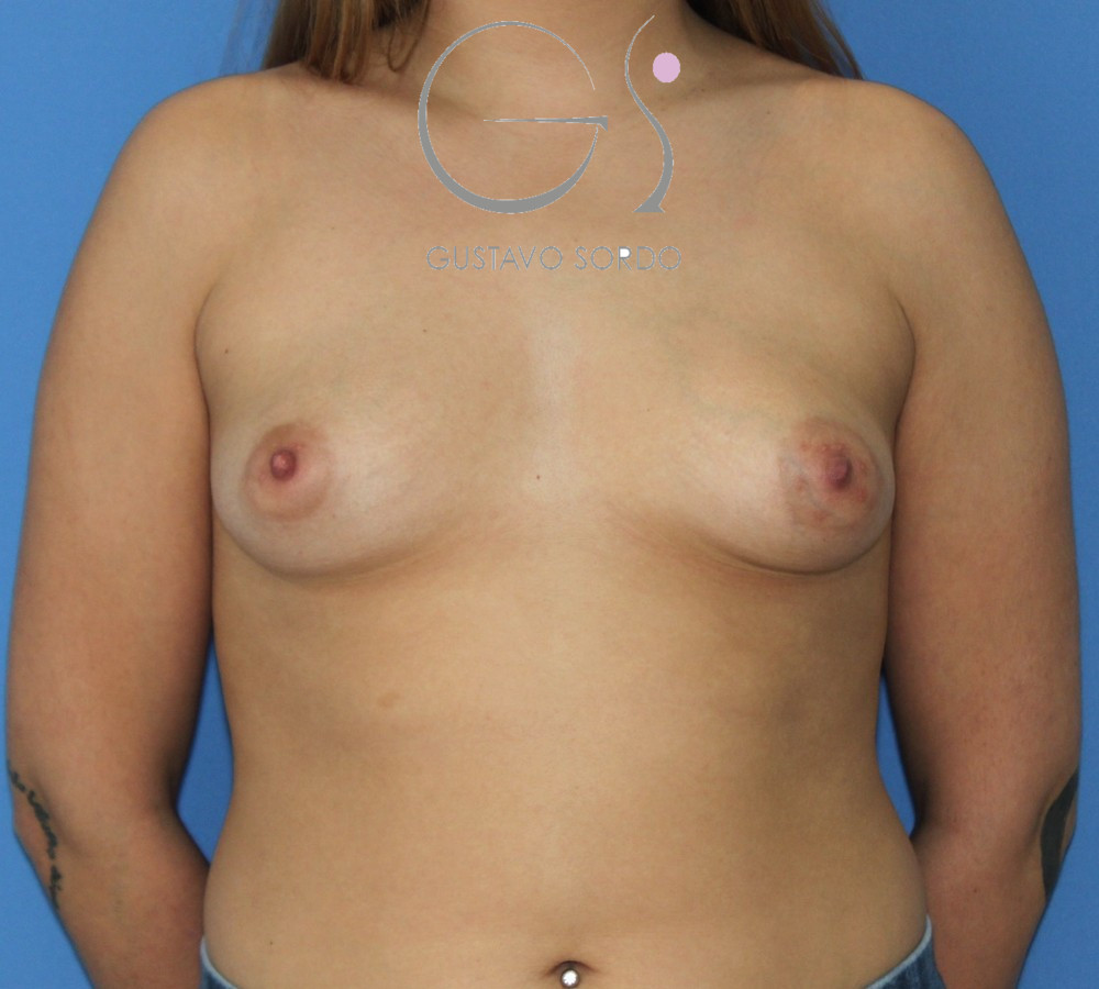 Mamas tuberosas de grado II corregidas con prótesis anatómicas de 375 cc: antes, vista frontal