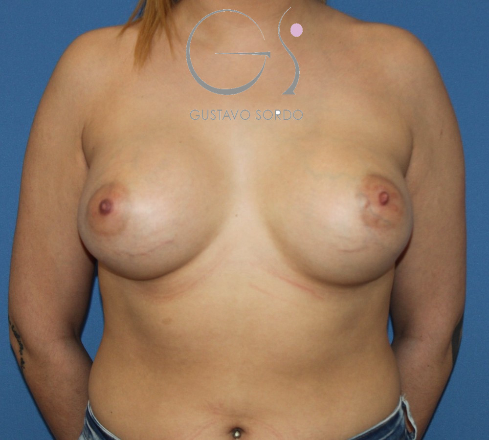 Mamas tuberosas de grado II corregidas con prótesis anatómicas de 375 cc: después, vista frontal