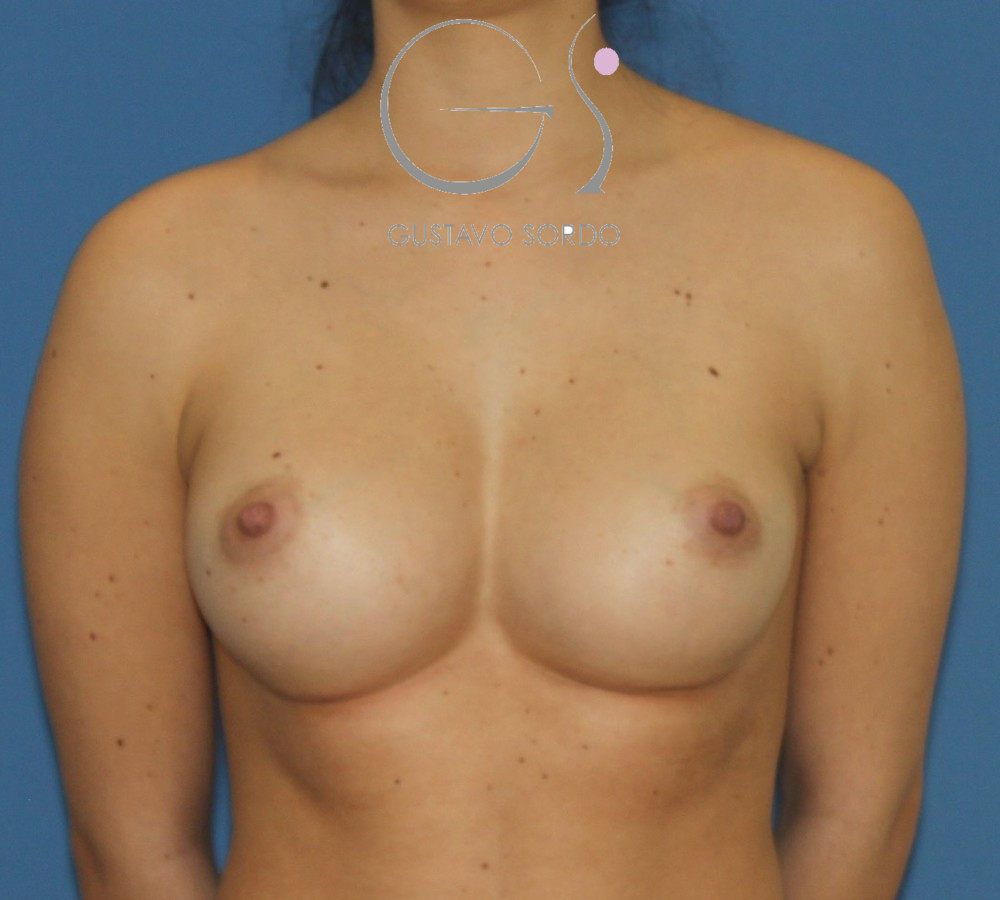 Aumento de pecho en pectus excavatum con prótesis anatómicas de 390 cc: después, vista frontal