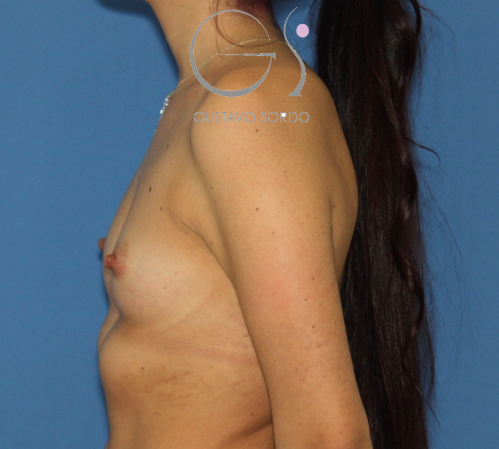 Aumento de pecho en pectus excavatum con prótesis anatómicas de 390 cc: antes, perfil derecho