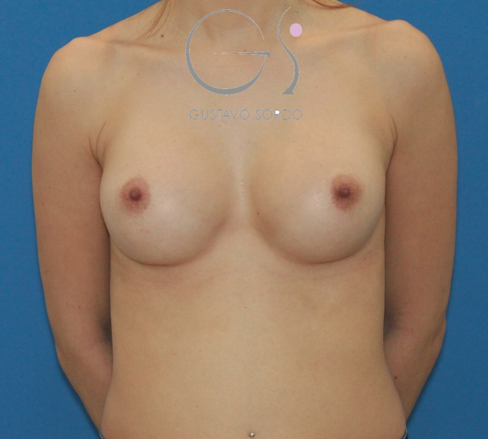 Aumento de pecho con prótesis anatómicas de 300 cc y resultado natural: después, vista frontal