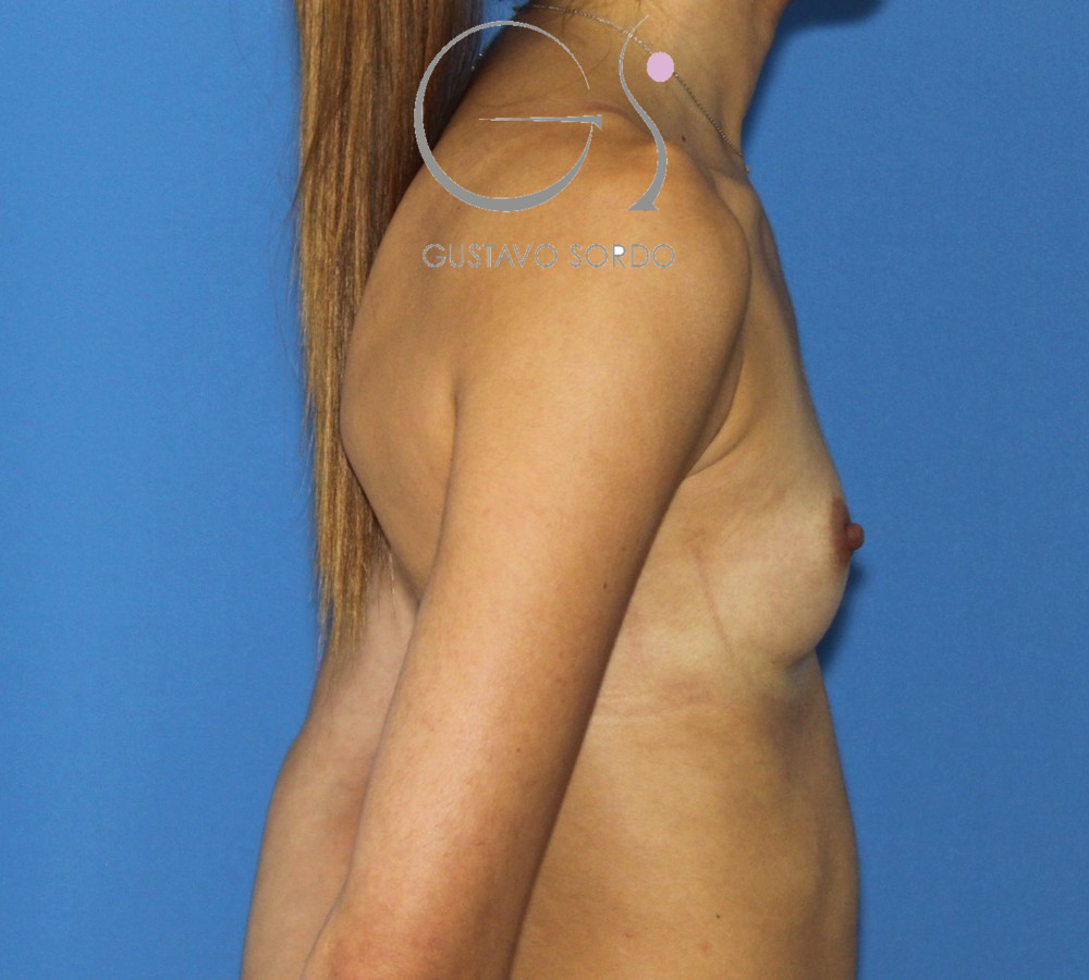 Aumento de pecho con prótesis anatómicas de 300 cc y resultado natural: antes, perfil derecho