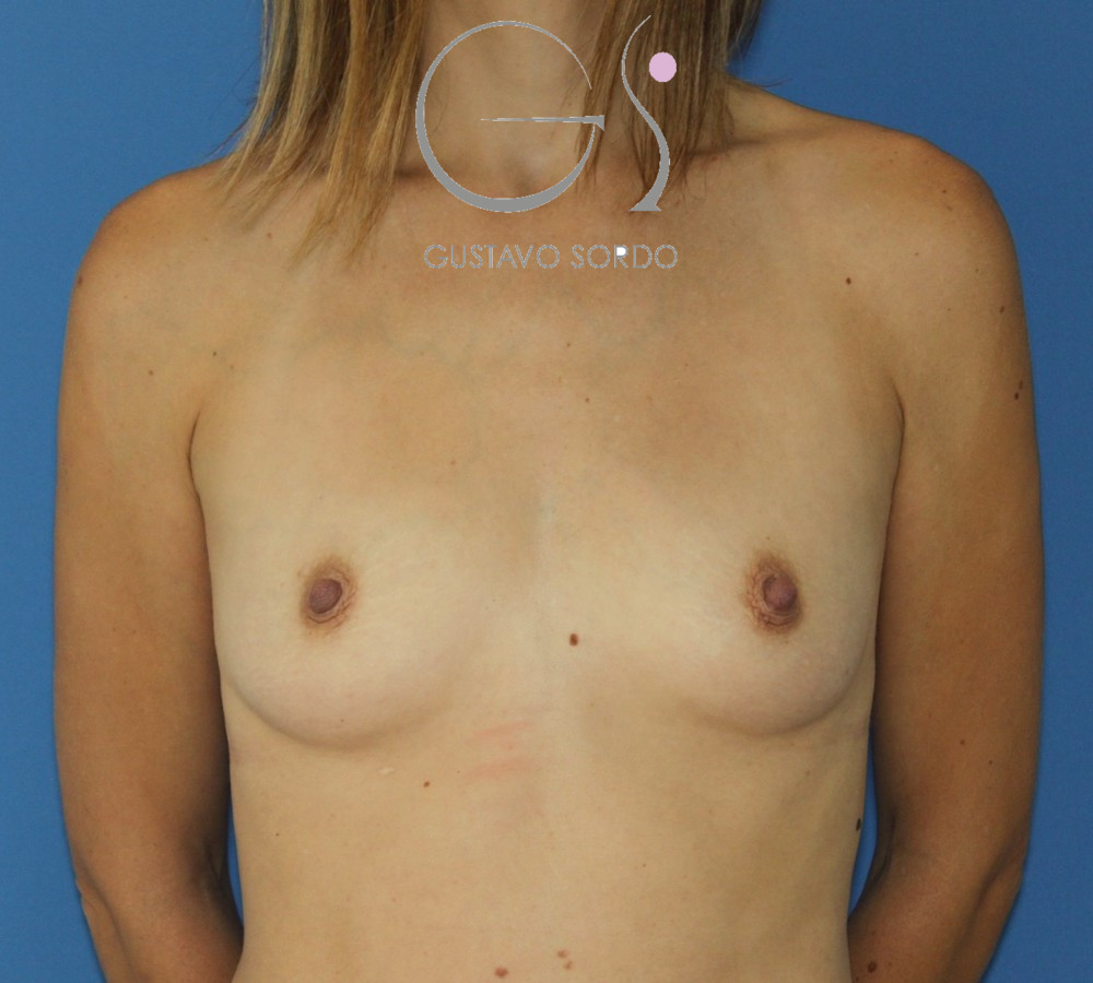 Aumento de pecho con prótesis anatómicas de 300 cc en mujer delgada: antes, vista frontal