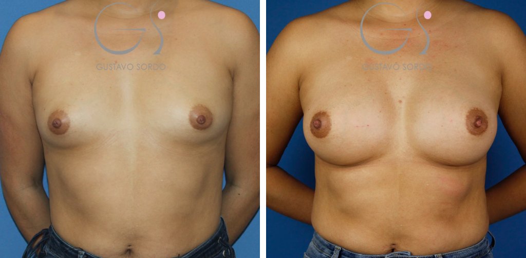 Aumento de pecho con implantes redondos de 315 cc: antes y después