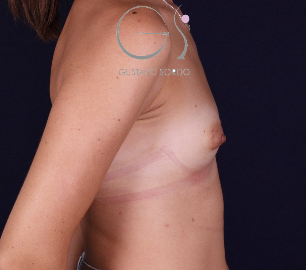 Aumento de pecho con implantes anatómicos de 345 cc, antes de la operación (2)