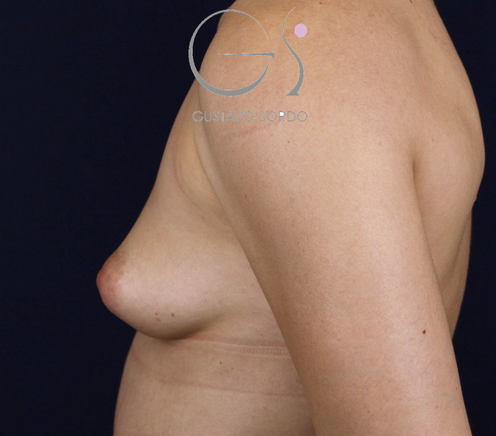 Aumento de pecho con implantes anatómicos de 330 cc en mama tuberosa, antes de la operación (5)