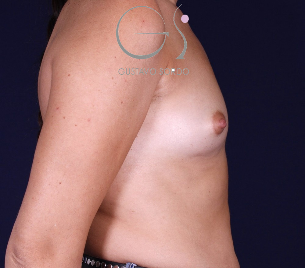 Aumento de pecho con implantes anatómicos de 345 cc en mama tuberosa, antes de la operación (2)