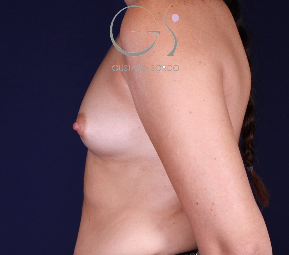 Aumento de pecho con implantes anatómicos de 345 cc en mama tuberosa, antes de la operación (5)