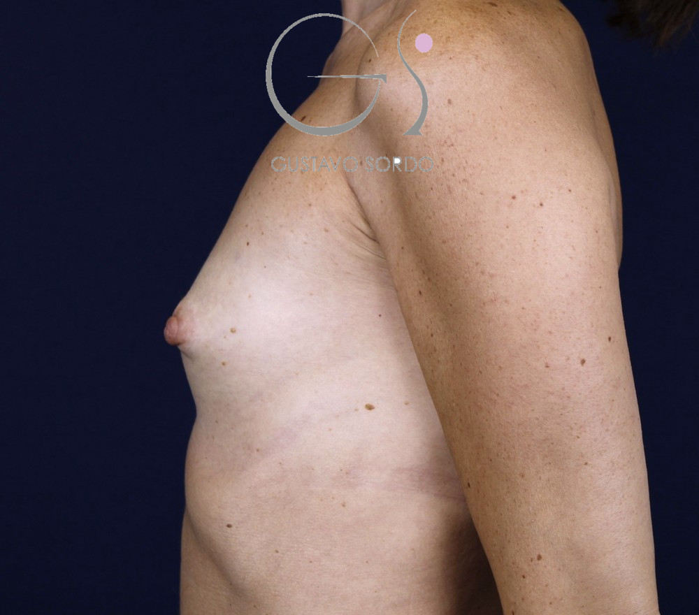 Aumento de pecho con implantes anatómicos de 330 cc, antes de la operación (5)