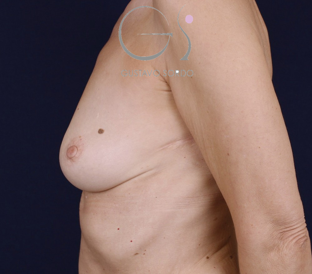 Aumento de pecho con implantes anatómicos de 390 cc, antes de la operación (5)