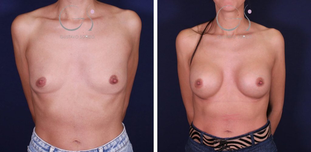 Aumento de pecho con implantes anatómicos de 270 cc: antes y después