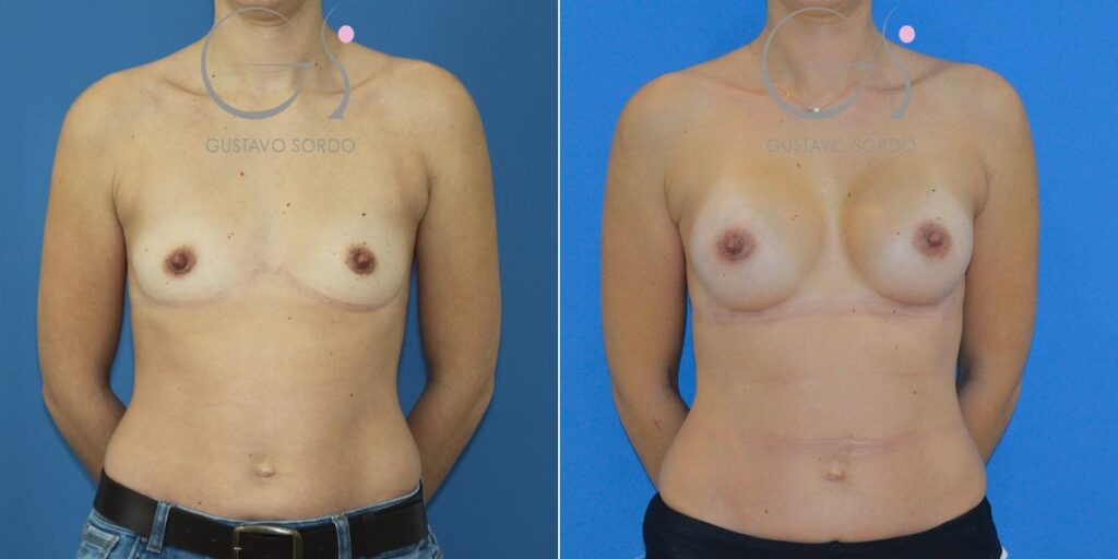 Antes y después de aumento de mamas con prótesis anatómicas de 300 cc en mujer de 35 años, Dr. Gustavo Sordo