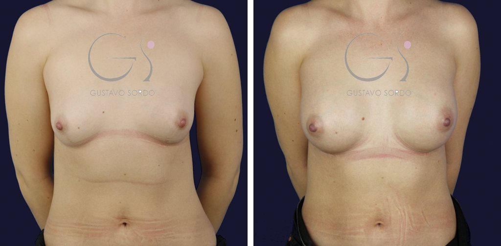 Antes y después de un aumento de pecho con prótesis anatómicas de 270 cc en mamas separadas, caso operado por el Dr. Gustavo Sordo en Madrid